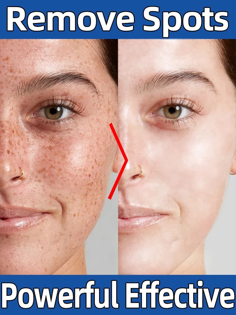 Freckles Age Sun Dark Spot Diminish