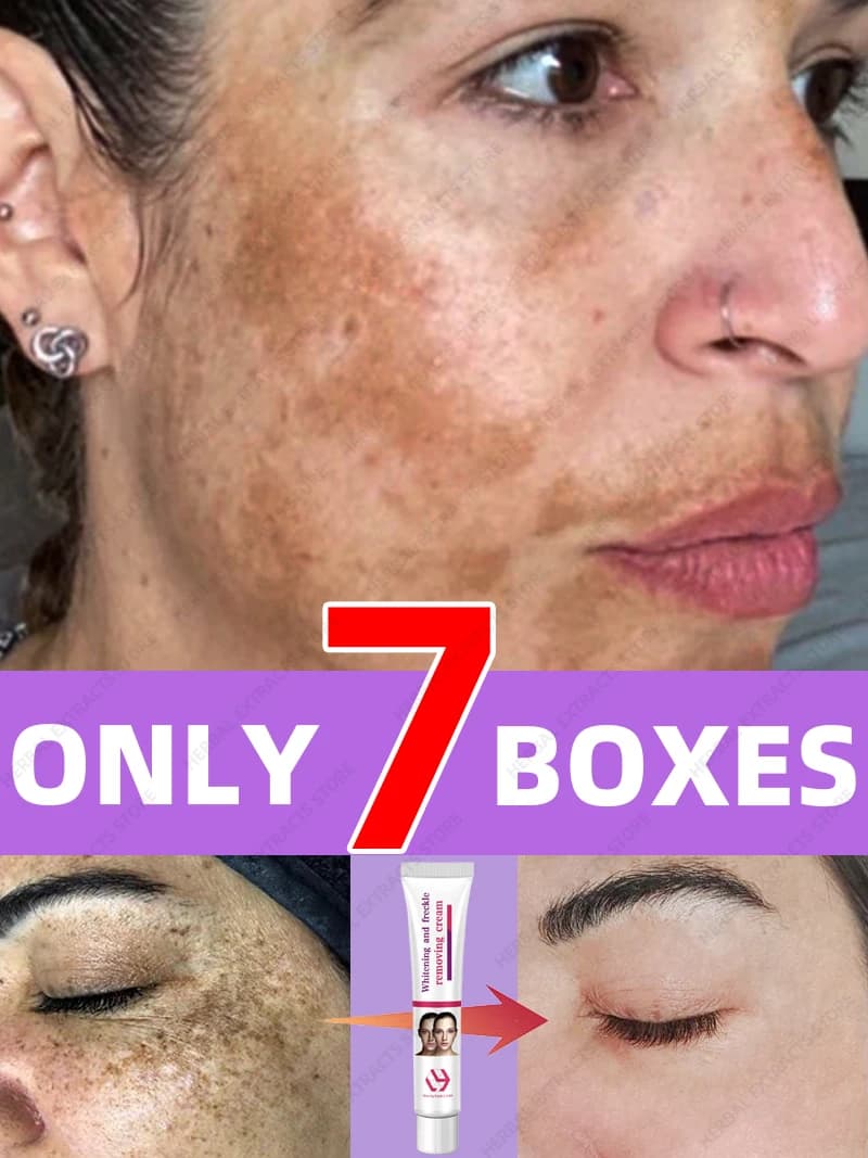 Freckles Sun Age Dark Spot Chloasma Diminish