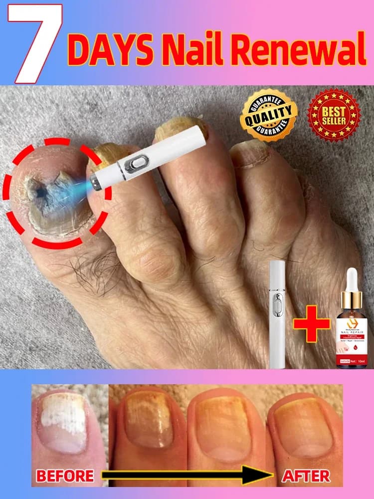 Laser Product To Solves Nail troubles