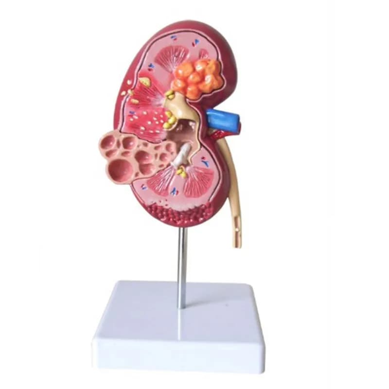 Lesion Kidney Model Human Anatomy Organ Medical Teaching Supplies