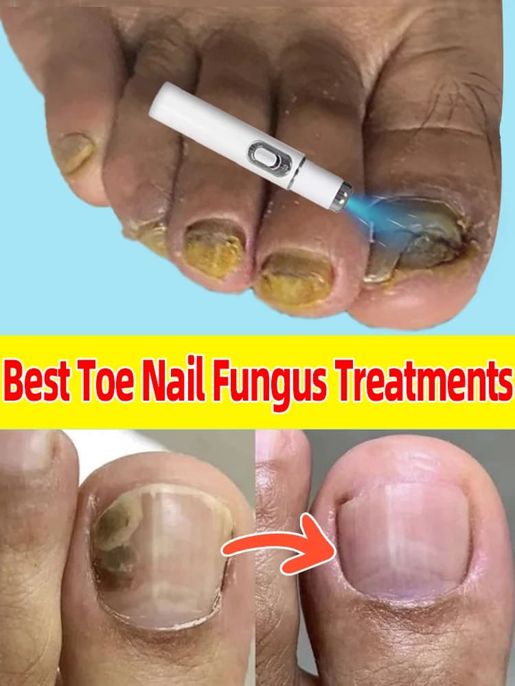 Solving the nail problem